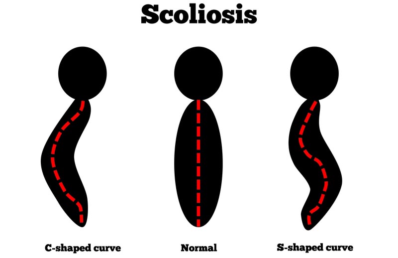 San Ramon and Surrounding Areas, California scoliosis treatment